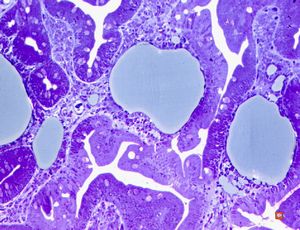 cured Whipple disease (semithin section) cured Whipple disease (semithin section)